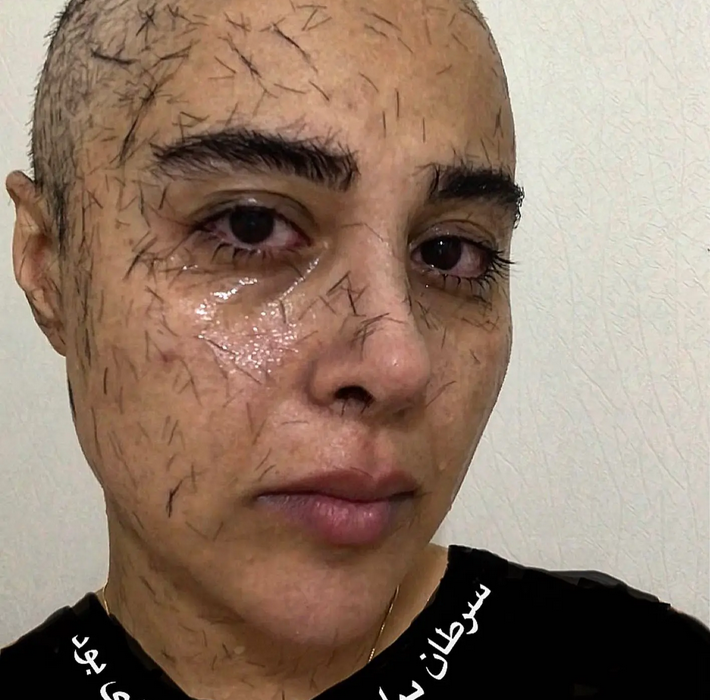 عکس جگرسوز بازیگر زن پس از شیمی درمانی سفید است!  لطفا برای سارا همتی دعا کنید